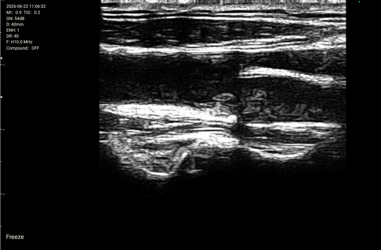 Interscalene brachial plexus in transverse section at 10.0 MHz