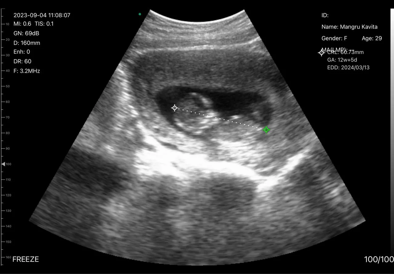 Fetal CRL measurement &mdash; 12w5d