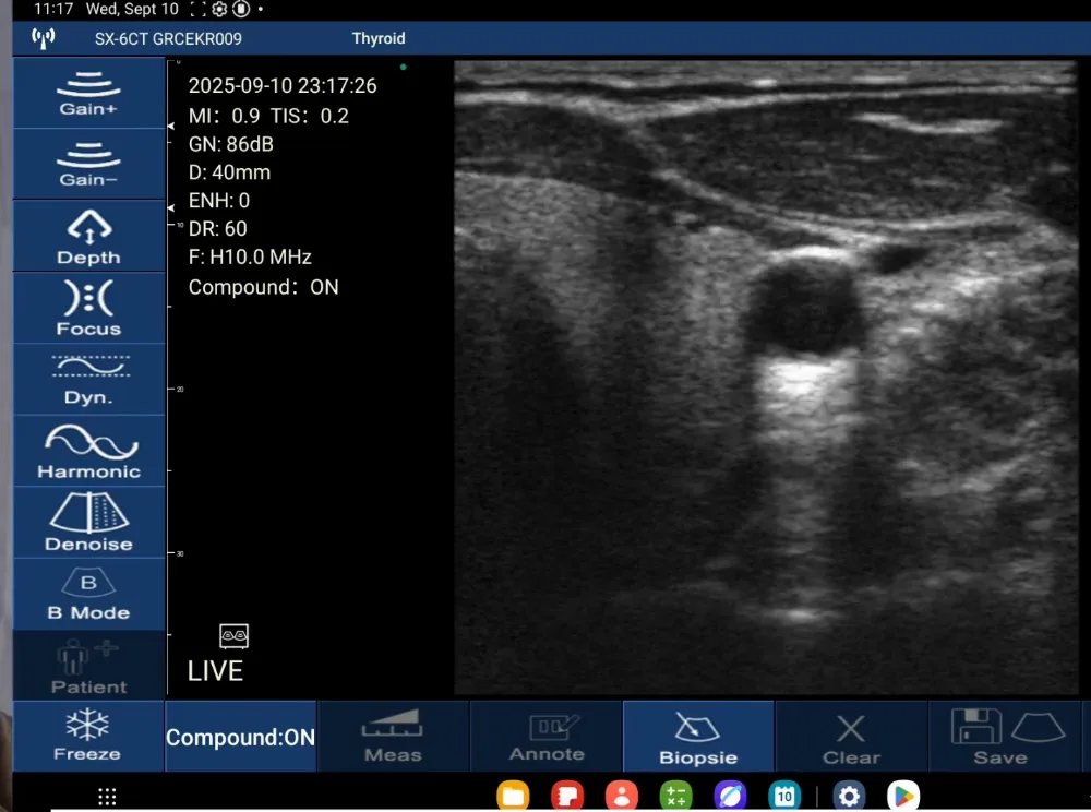 Thyroid transverse &mdash; live scan interface