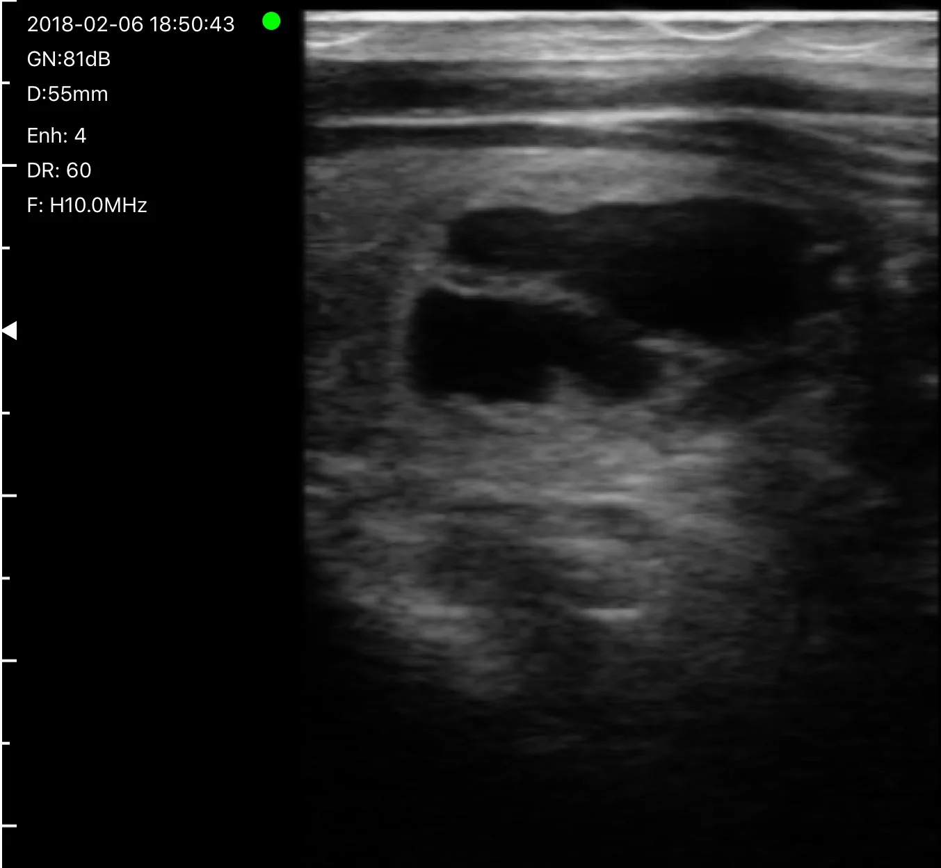 Thyroid nodule with cystic and solid components at 10 MHz