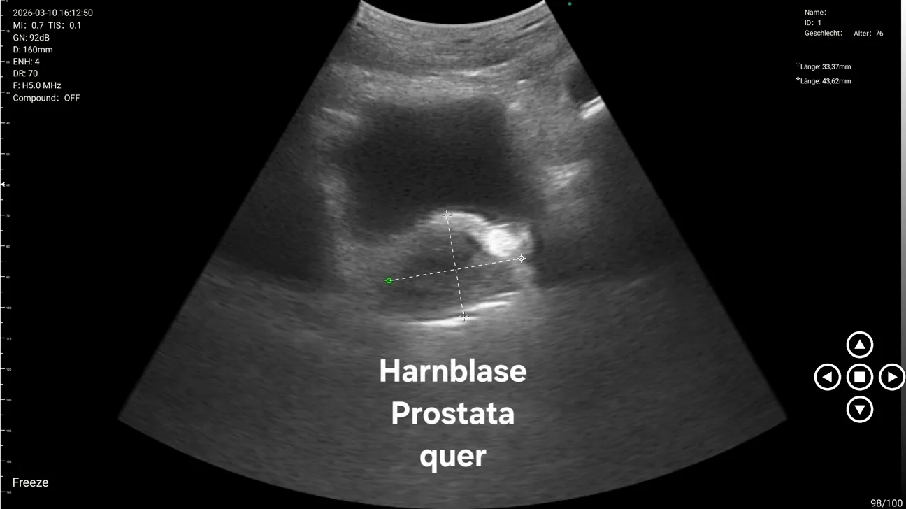 Transverse bladder and prostate