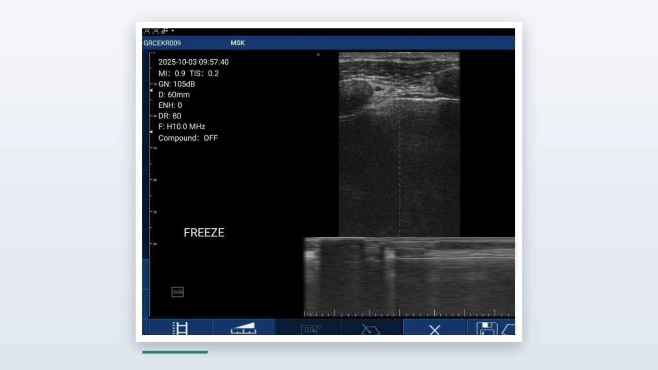 Suresult D3Ultra handheld ultrasound interface during a lung scan: pleural line and A-lines in B-mode with the M-mode seashore sign below, MSK preset at 60 mm depth and H10.0 MHz