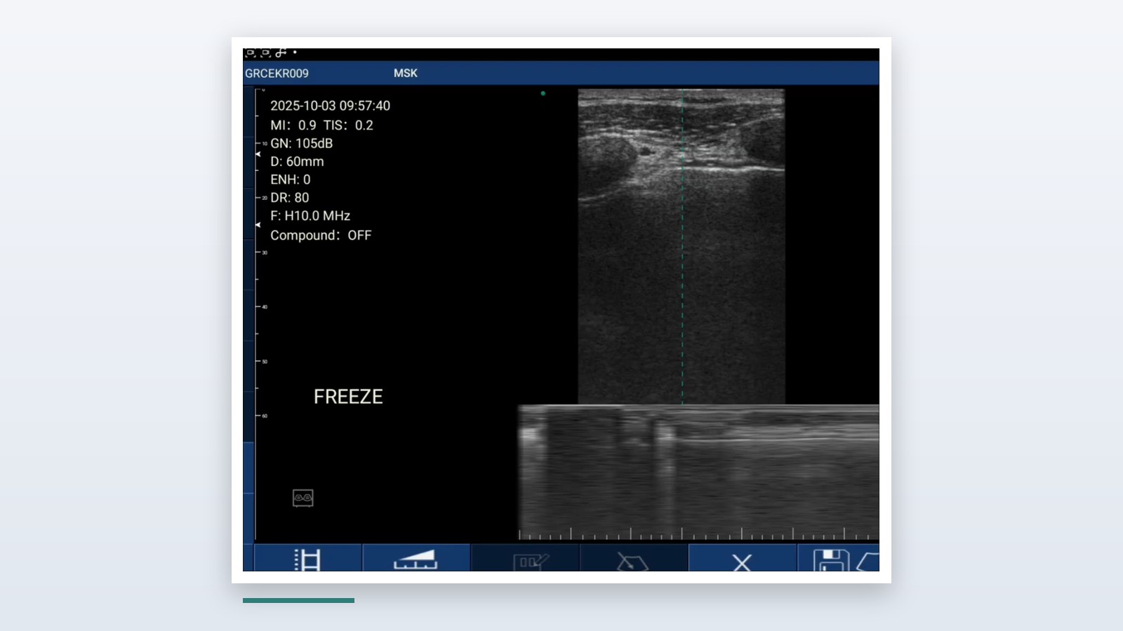 Suresult D3Ultra handheld ultrasound interface during a lung scan: pleural line and A-lines in B-mode with the M-mode seashore sign below, MSK preset at 60 mm depth and H10.0 MHz