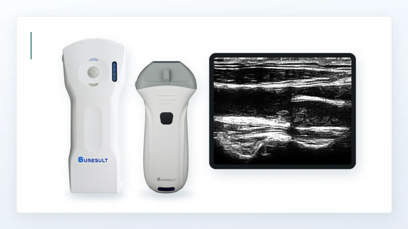 Kabellose Ultraschallsonden Suresult D3Ultra und L14Pro neben einer interskalenären Ultraschallaufnahme des Plexus brachialis