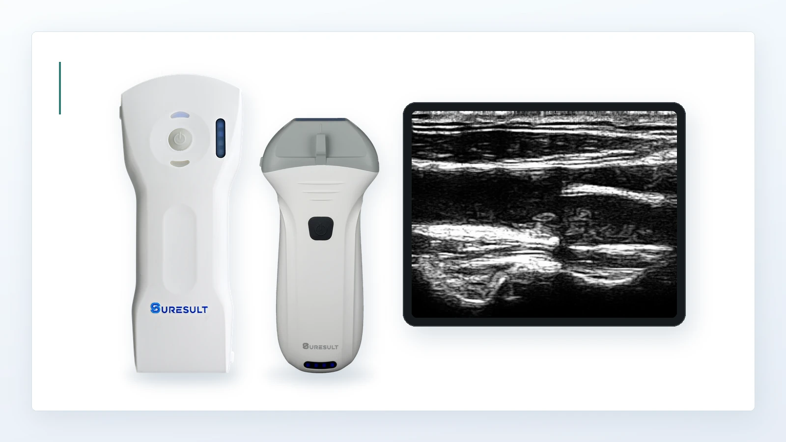 Sondas ecográficas inalámbricas Suresult D3Ultra y L14Pro junto a una imagen ecográfica interescalénica del plexo braquial