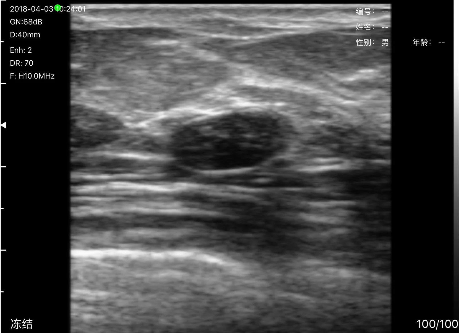 Breast Care: breast 02 hypoechoic breast nodule 40 mm depth