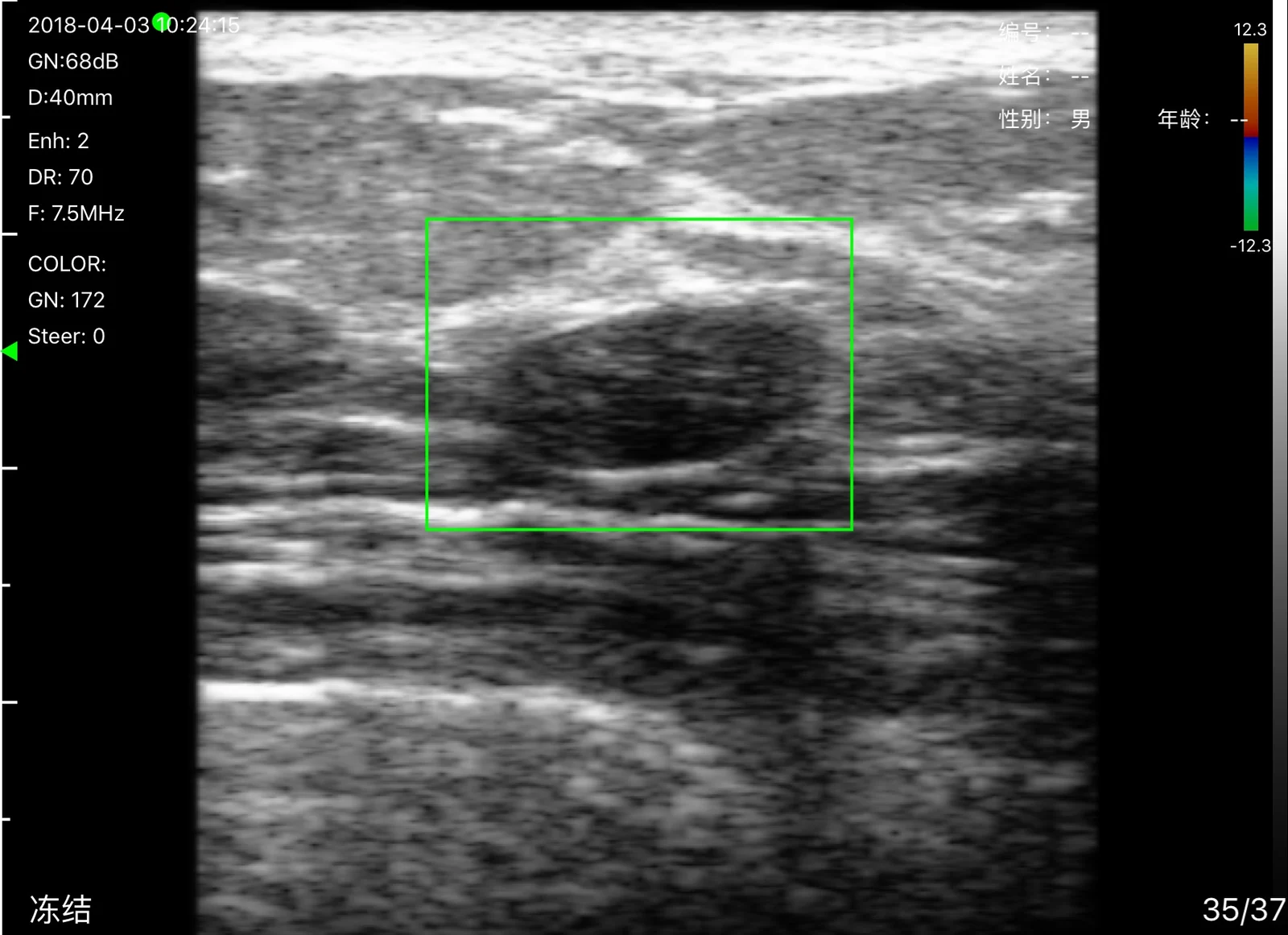 Color box placed over the same nodule