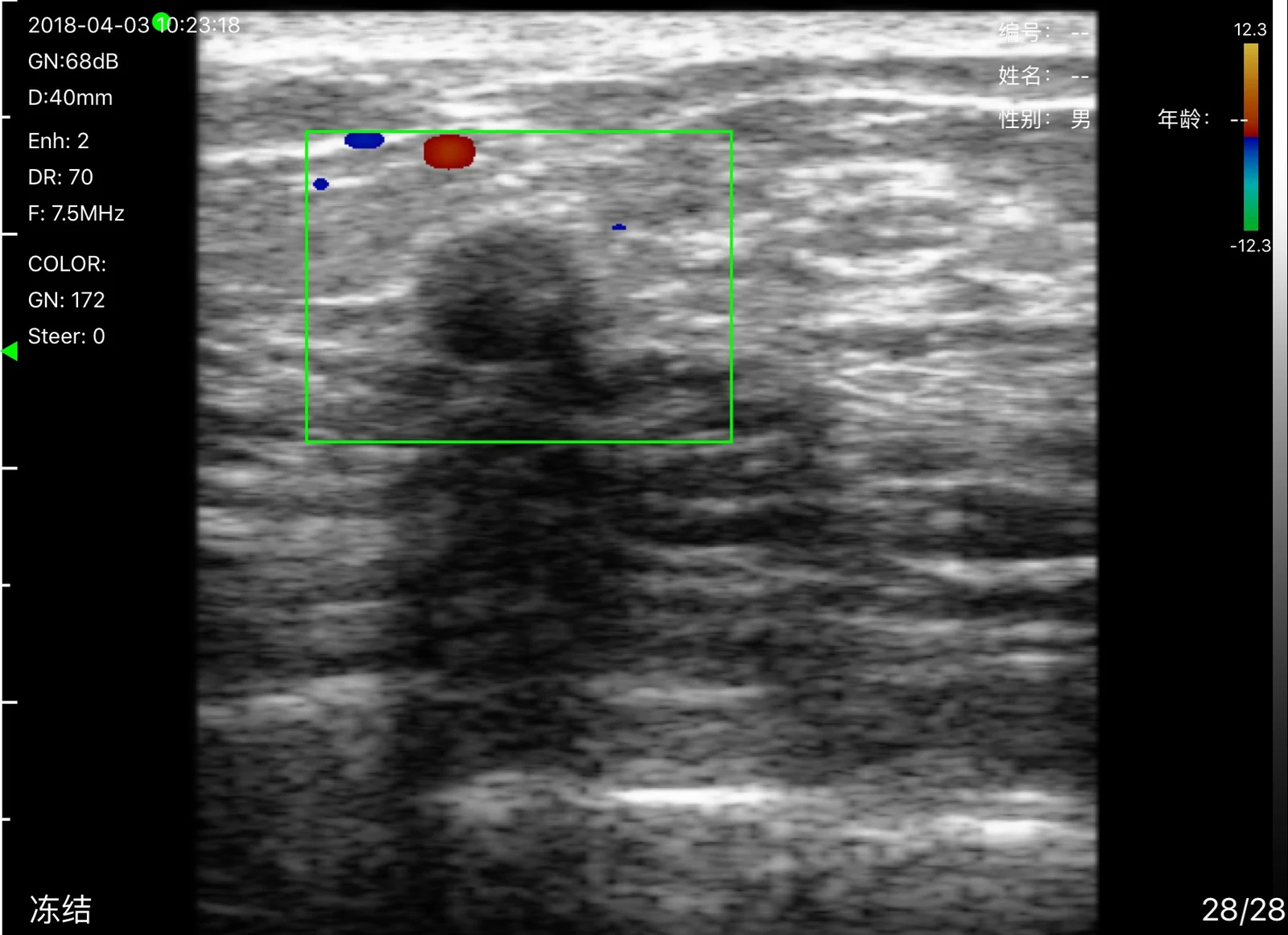 Color Doppler picks up two superficial vessels beside the lesion