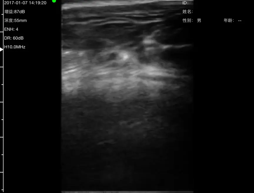 Ten-second breast tissue sweep to 55 mm