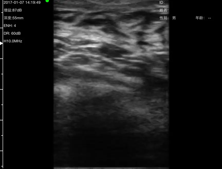 Second sweep through the same breast