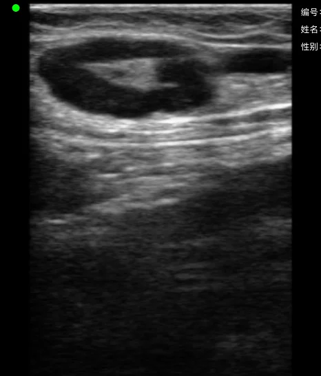 Superficial lymph node with an echogenic hilum