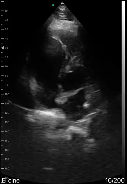 Apical window ultrasound view on a Suresult handheld