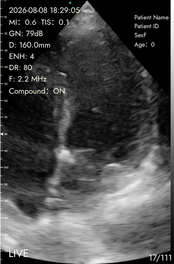 Apical four-chamber ultrasound view on a Suresult handheld