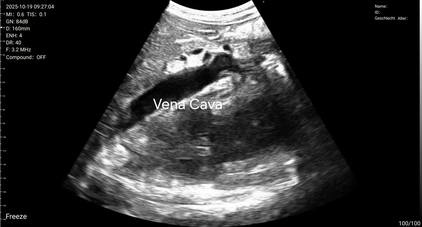Inferior vena cava ultrasound view on a Suresult handheld