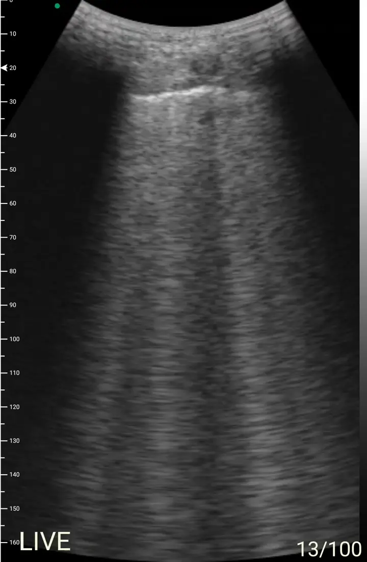 Lung B-lines ultrasound view on a Suresult handheld
