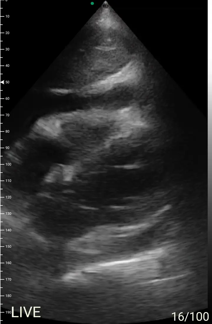Pericardial effusion ultrasound view on a Suresult handheld