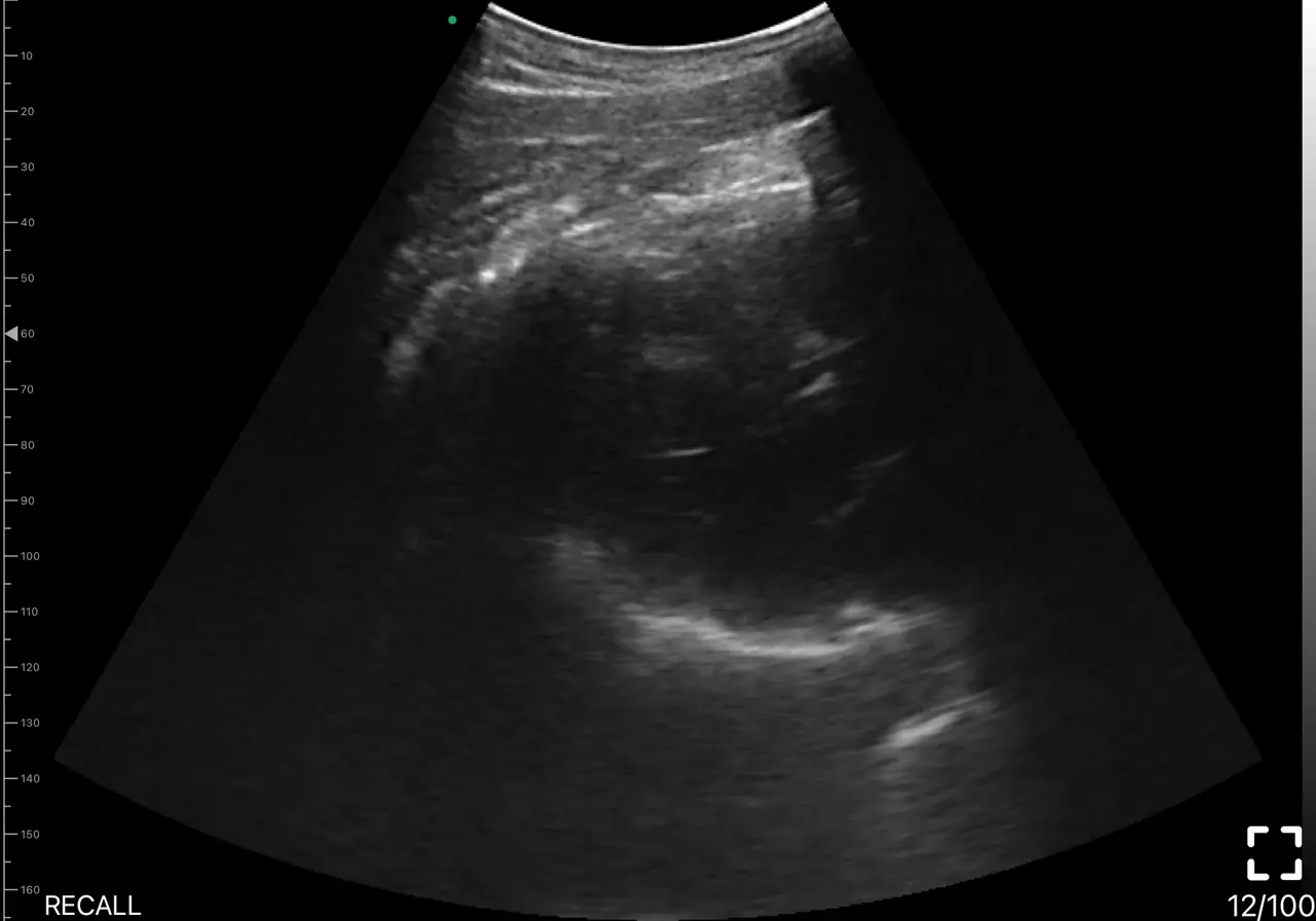 Parasternal long axis ultrasound view on a Suresult handheld