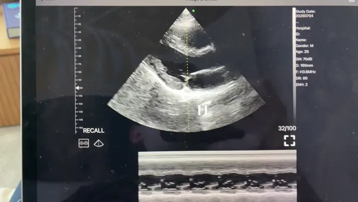 Short axis with M-mode ultrasound view on a Suresult handheld