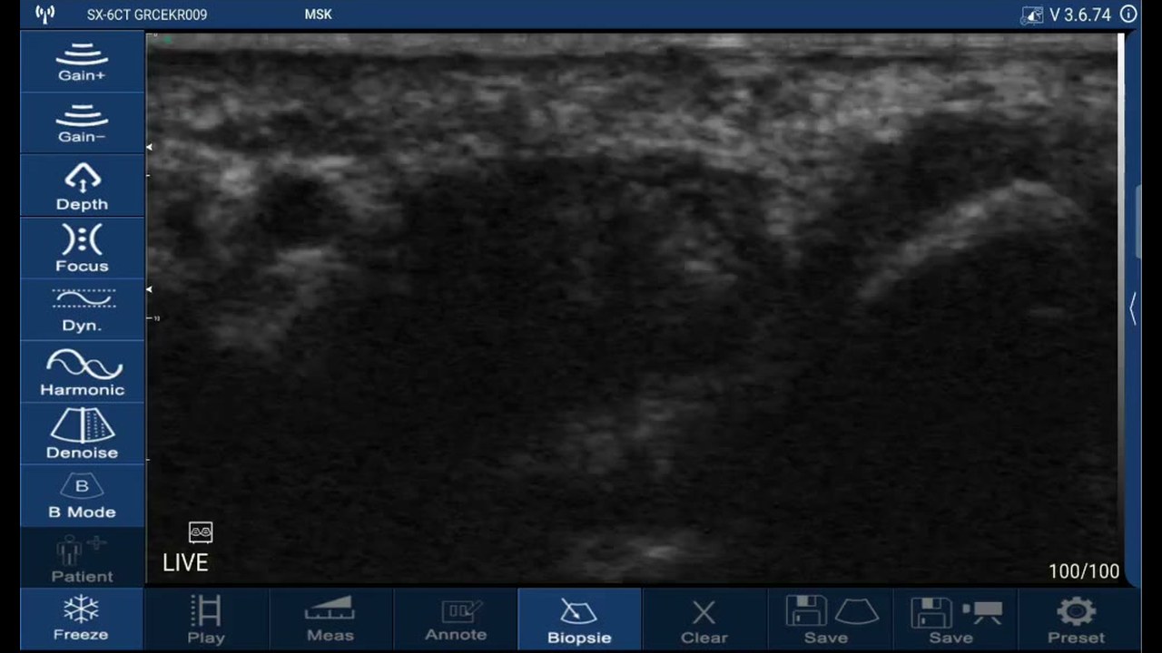 Live transverse ultrasound of the anterior wrist on a Suresult D3Ultra showing the flexor tendons and the median nerve among them, MSK preset at 20 mm depth