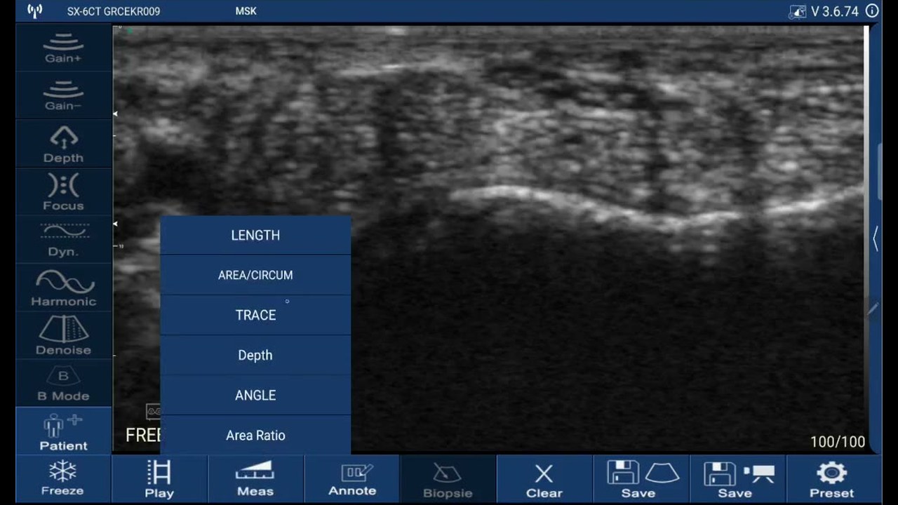 Measurement menu open on a Suresult D3Ultra over a frozen transverse wrist image, listing LENGTH, AREA/CIRCUM, TRACE, Depth, ANGLE and Area Ratio