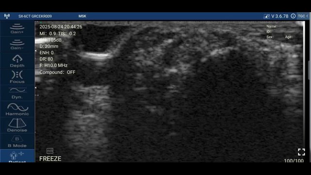 First extensor compartment of the wrist on a handheld linear ultrasound, the scan used to look for tenosynovitis at the radial styloid