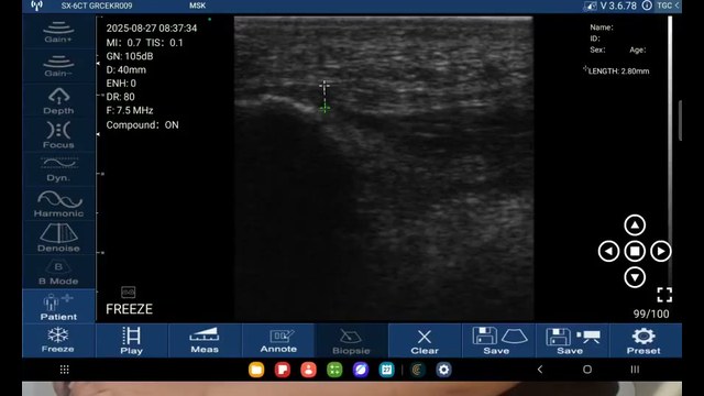 Plantar fascia measured at its calcaneal insertion on a handheld linear ultrasound, thickness caliper on screen