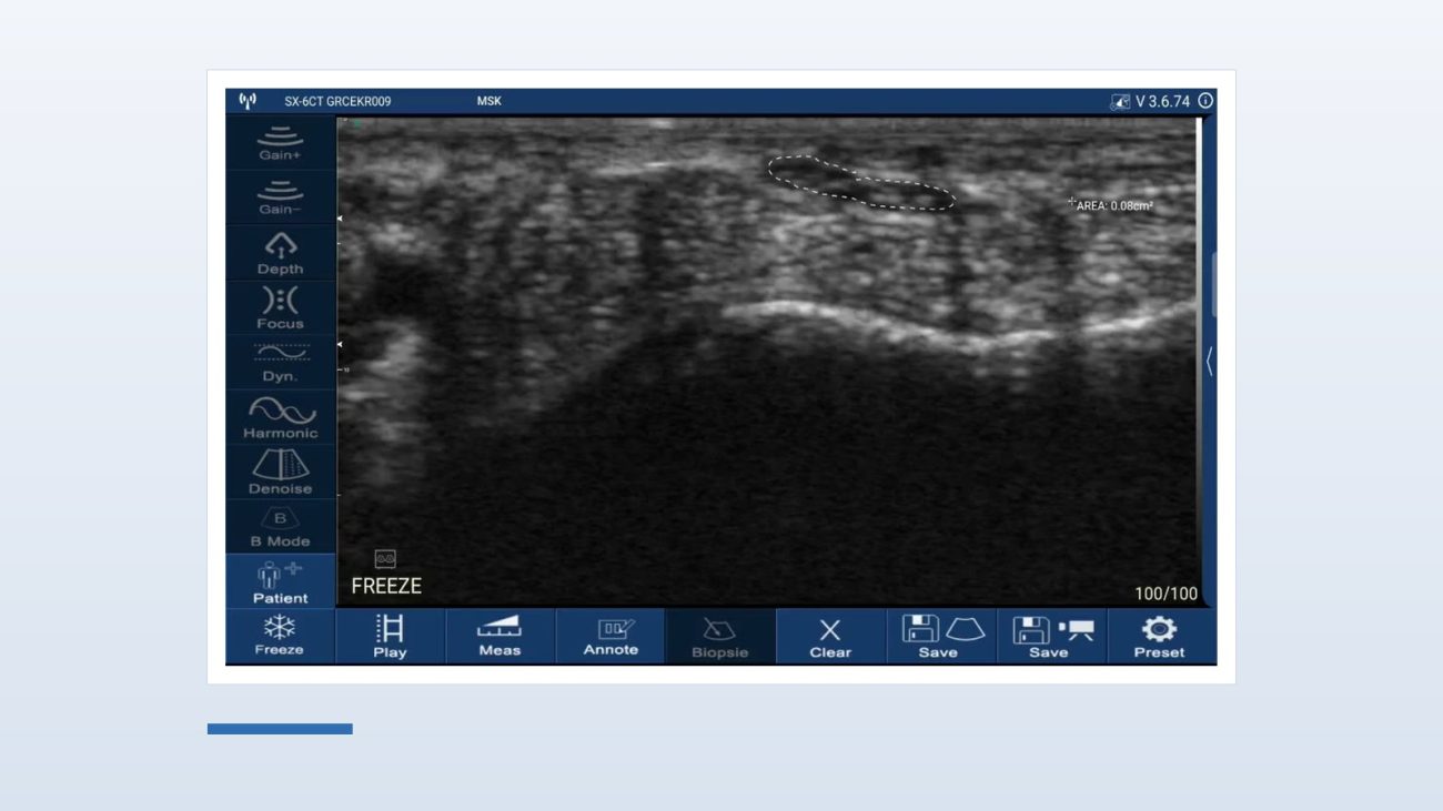 Median nerve traced in cross-section at the wrist on a Suresult D3Ultra handheld ultrasound, with the on-screen area reading 0.08 cm² on the MSK preset at 20 mm depth