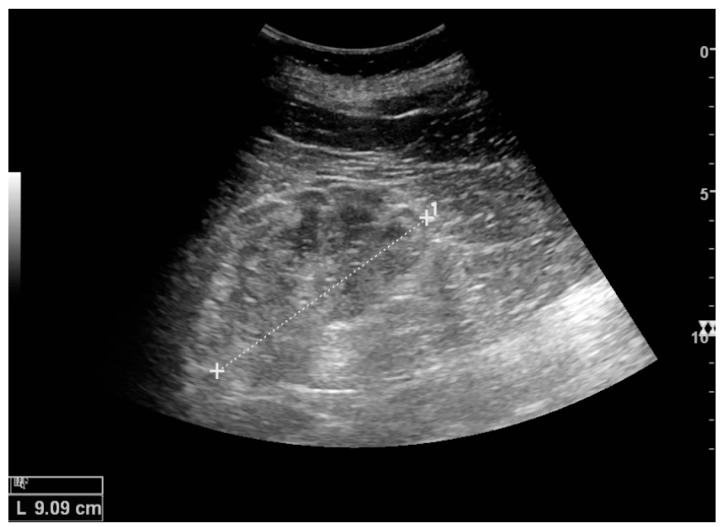 Chronic renal parenchymal change ultrasound thumbnail
