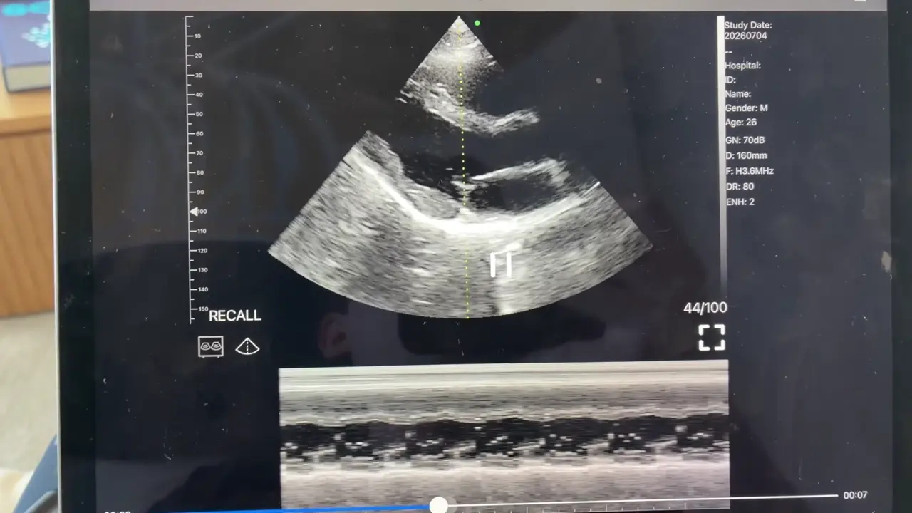 Parasternal long axis with M-mode on the CD2
