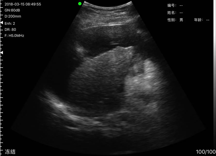 Perihepatic free fluid