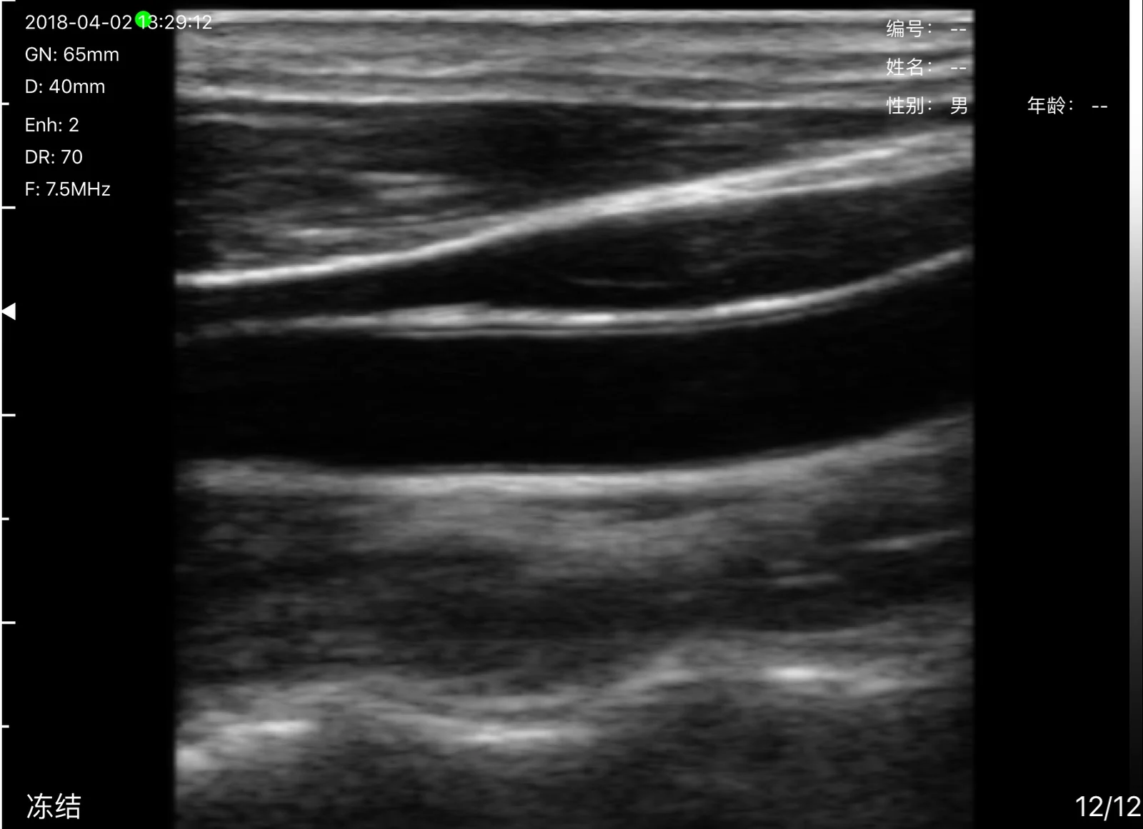 Common carotid artery and internal jugular vein in long axis