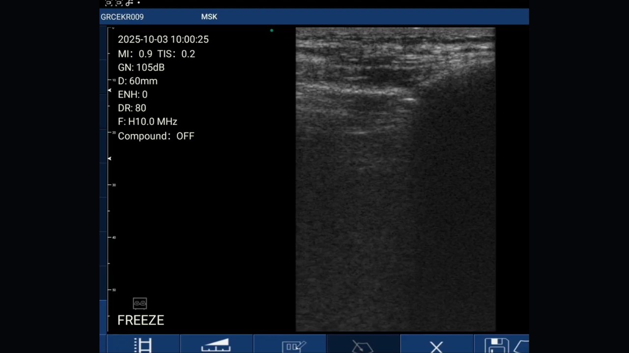 Frozen lung-base frame on a handheld ultrasound: bright air-filled lung across the upper sector blocking the view of the liver behind it, MSK preset at 60 mm depth and H10.0 MHz