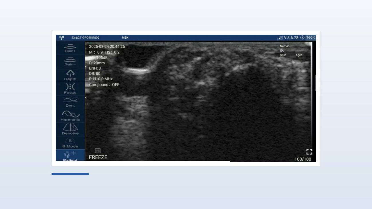 First extensor compartment of the wrist frozen on a Suresult D3Ultra handheld ultrasound, MSK preset at 20 mm depth and H10.0 MHz, read as normal