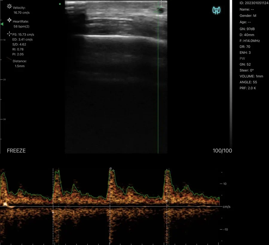Pulsed-wave trace on a superficial facial vessel