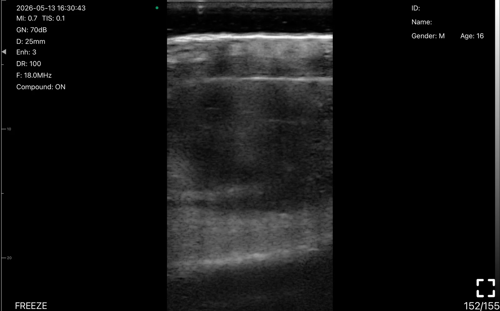 Scalp soft-tissue collection at 18 MHz