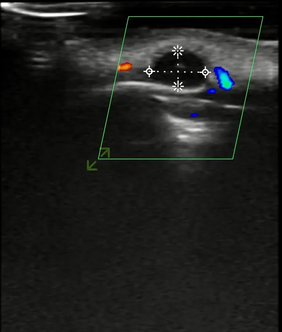 Superficial lesion measured with color flow at its margin