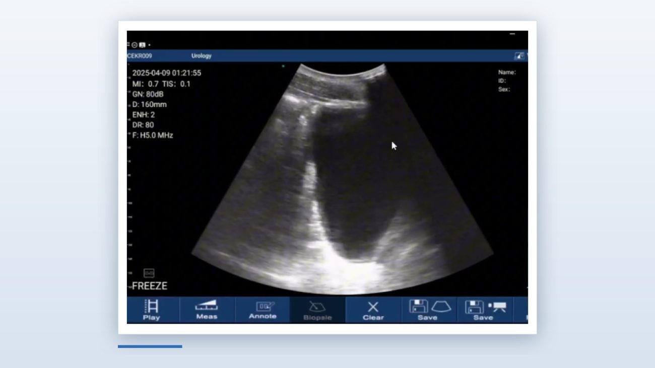 Suprapubic pelvic window of an eFAST exam on the Suresult D3Ultra handheld ultrasound, bladder filling the near field at 160 mm depth