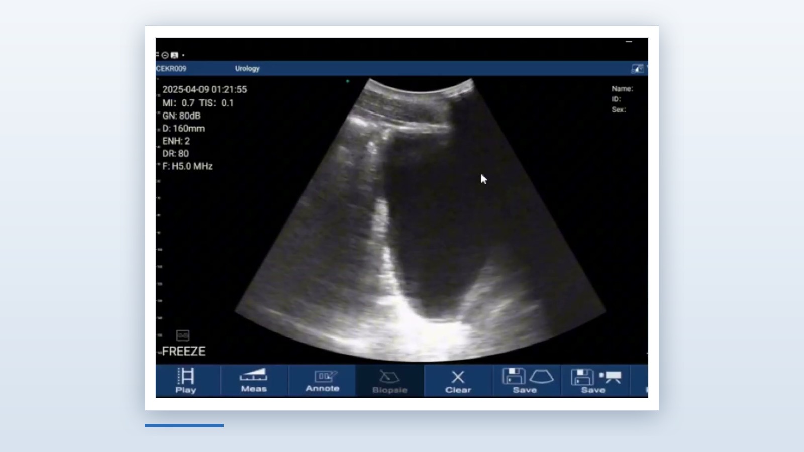 Suprapubic pelvic window of an eFAST exam on the Suresult D3Ultra handheld ultrasound, bladder filling the near field at 160 mm depth