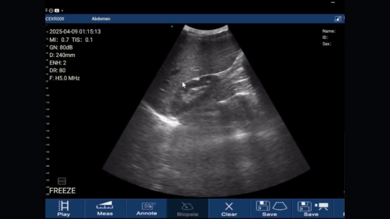 Right upper quadrant scan on a handheld ultrasound: liver and right kidney with the hepatorenal recess between them, Abdomen preset at 240 mm depth