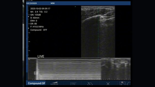 Lung ultrasound frame from the BLUE protocol walkthrough showing the pleural line and A-lines on a handheld probe
