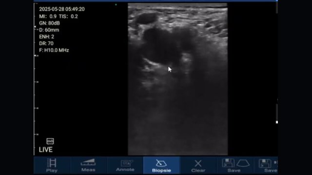 Three-point compression DVT scan frame on a handheld linear probe showing a vein under compression