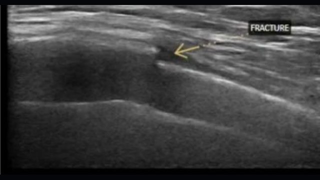 High-frequency linear ultrasound frame of the rib cortex used to look for a cortical step-off