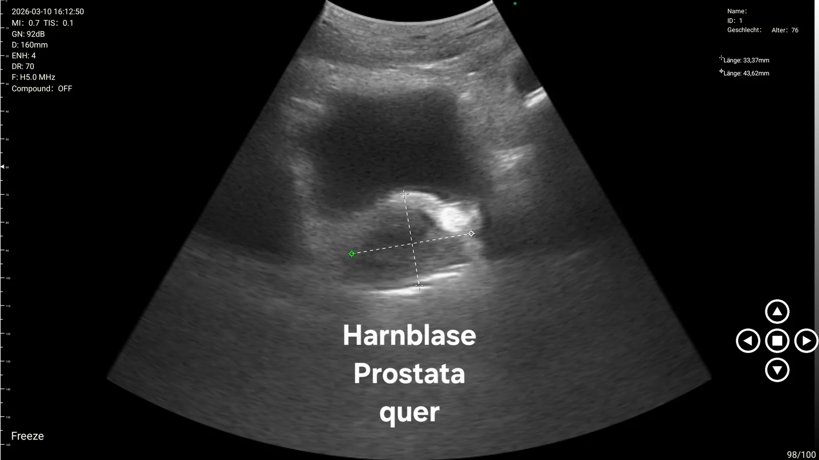 Emergency Medicine: emergency 03 suprapubic bladder prostate view d3ultra