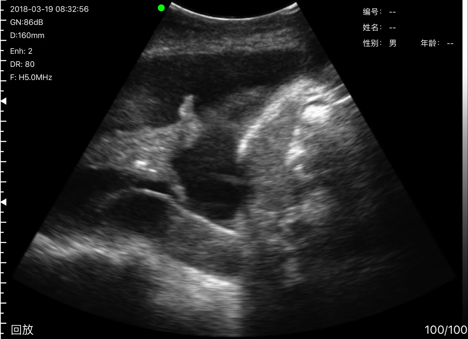 Anechoic pleural collection above the diaphragm