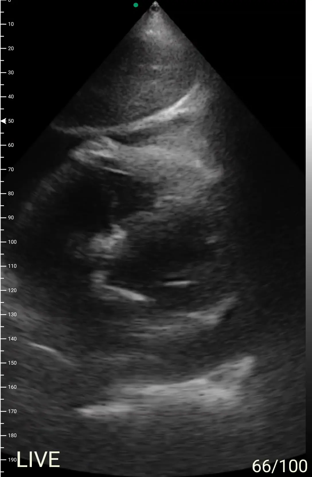 Pericardial effusion on the D3Ultra