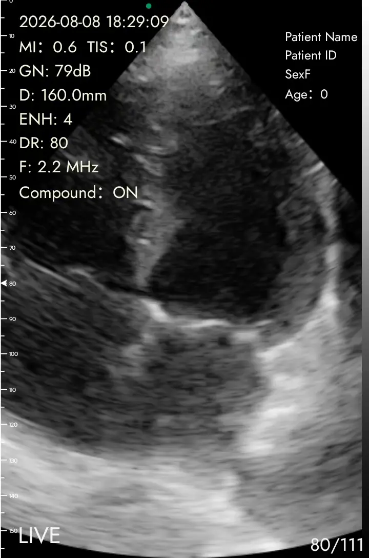 Apical four-chamber on the PD1