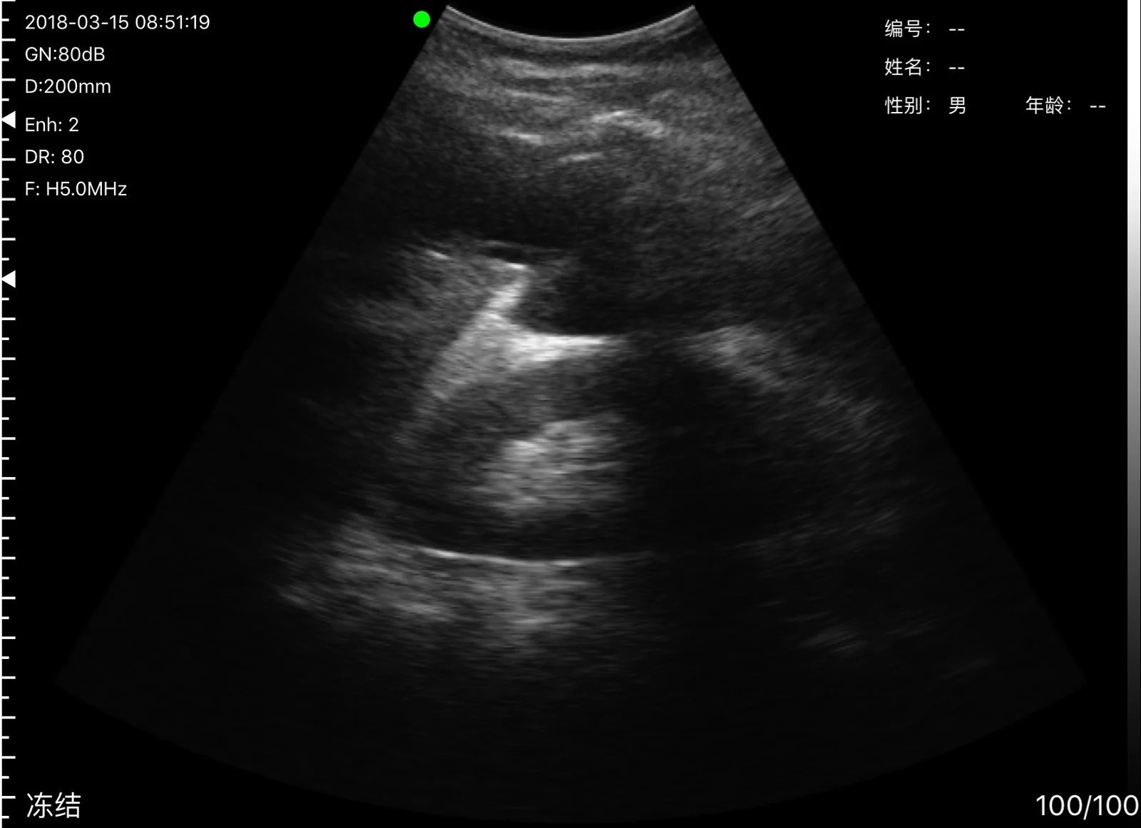Free fluid between the liver and the right kidney