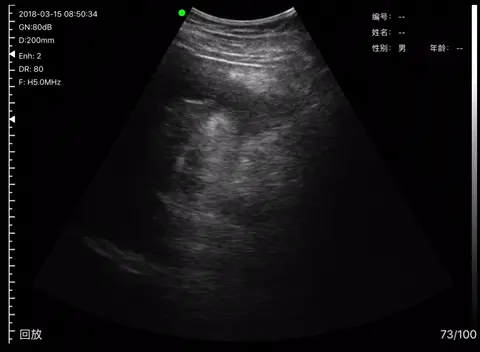 Free fluid around the liver edge