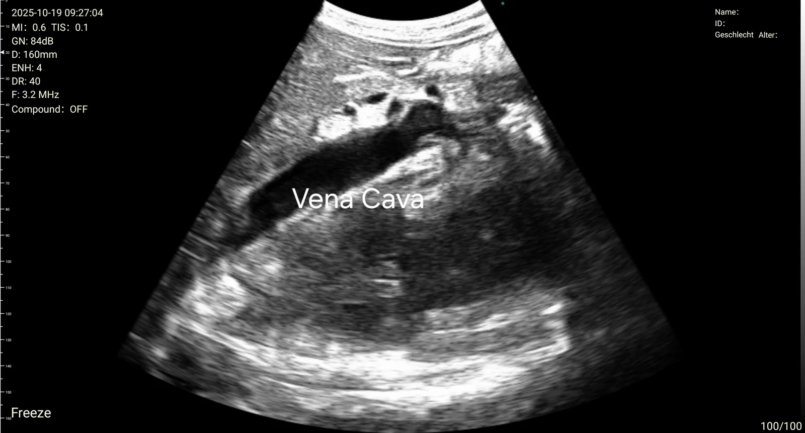 Inferior vena cava, labeled on screen