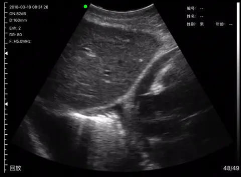 Pleural effusion with pericardial fluid